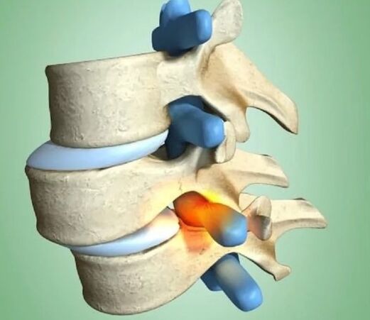 Vertebra- ի անկայուն դիրքը